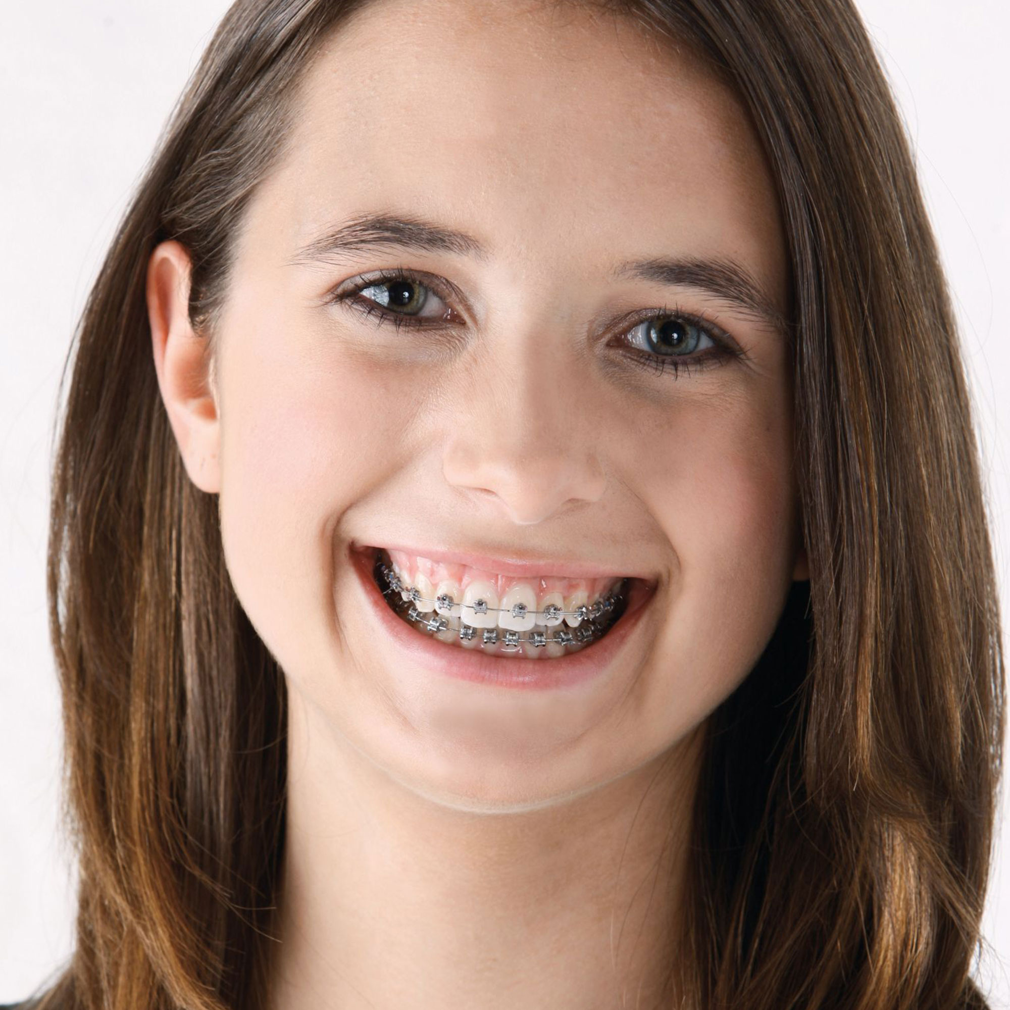 metal braces on plastic model